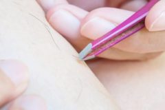 脚のムダ毛脱毛の注意点