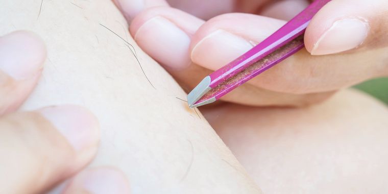 脚のムダ毛脱毛の注意点